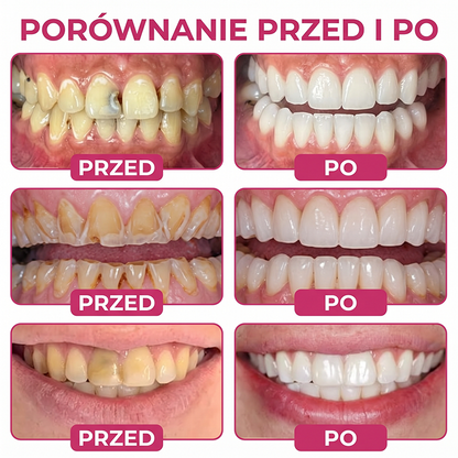 Rolimey® DenPerm – Naturalny żel wypełniający szkliwo do leczenia ubytków próchnicowych🌟