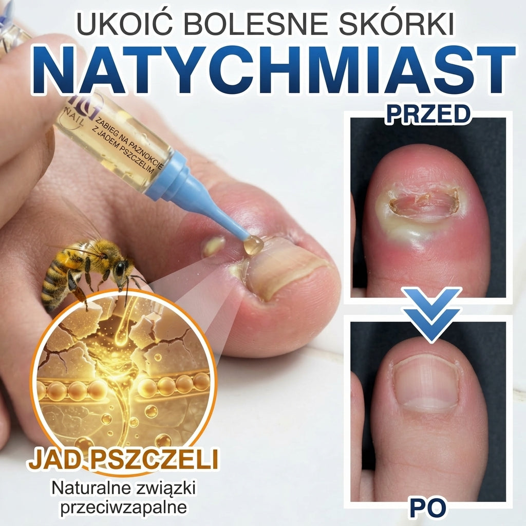 🇪🇺 Certyfikowany w UE 👩‍🔬 CareBreeze® Fungi Free – Intensywna Kuracja do Paznokci na Bazie Jadu Pszczelego 🥉