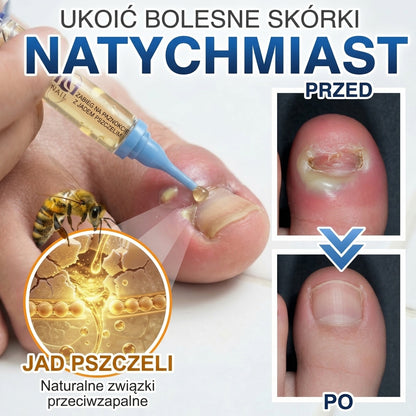 🇪🇺 Certyfikowany w UE 👩‍🔬 CareBreeze® Fungi Free – Intensywna Kuracja do Paznokci na Bazie Jadu Pszczelego 🥉