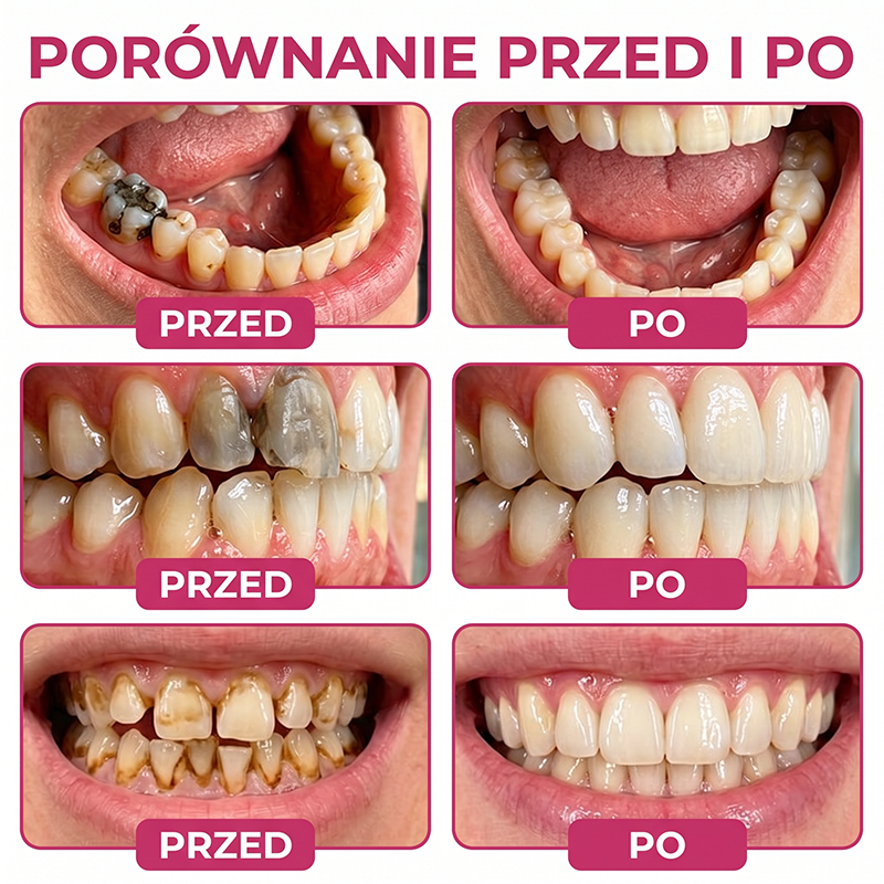 Rolimey® DenPerm – Naturalny żel wypełniający szkliwo do leczenia ubytków próchnicowych🌟